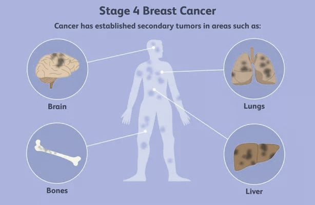 Cancer ke stages kya hai?