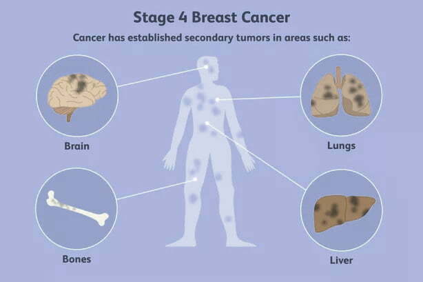 Cancer ke stages kya hai?